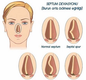 Septoplasti (Burun Kemik-Kıkırdak Eğriliği)