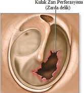 Timpanoplasti (Kulak Zarı Onarılması)