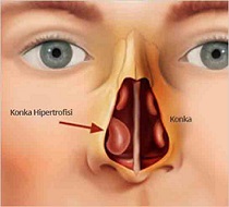 Konka Hipertrofisi (Burun Eti Büyümesi)